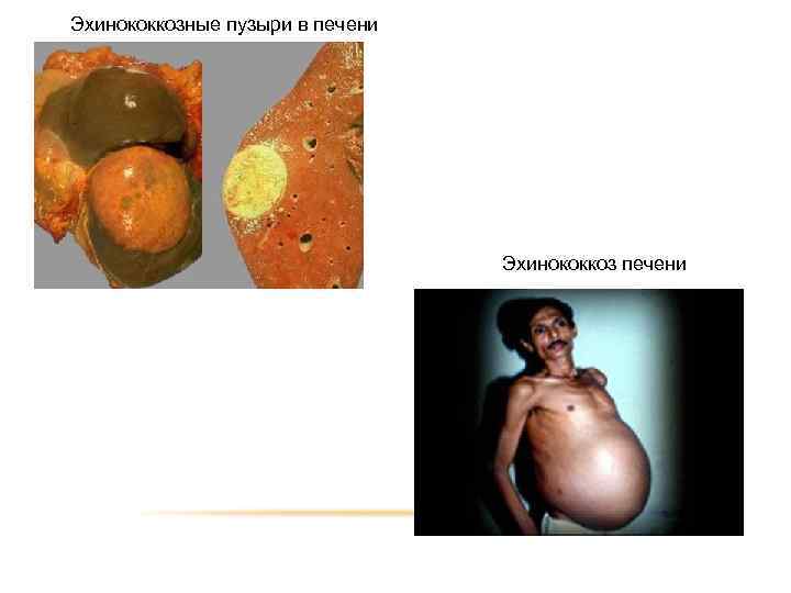 Эхинококкозные пузыри в печени Эхинококкоз печени 