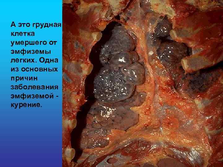  А это грудная клетка умершего от эмфиземы легких. Одна из основных причин заболевания