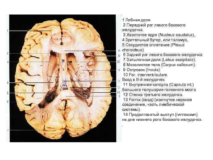 1 Лобная доля. 2 Передний рог левого бокового желудочка. 3 Хвостатое ядро (Nucleus caudatus),
