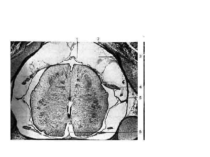 1 - pia mater; 2 - dura mater и arachnoides; 3 - подпаутинное пространство;