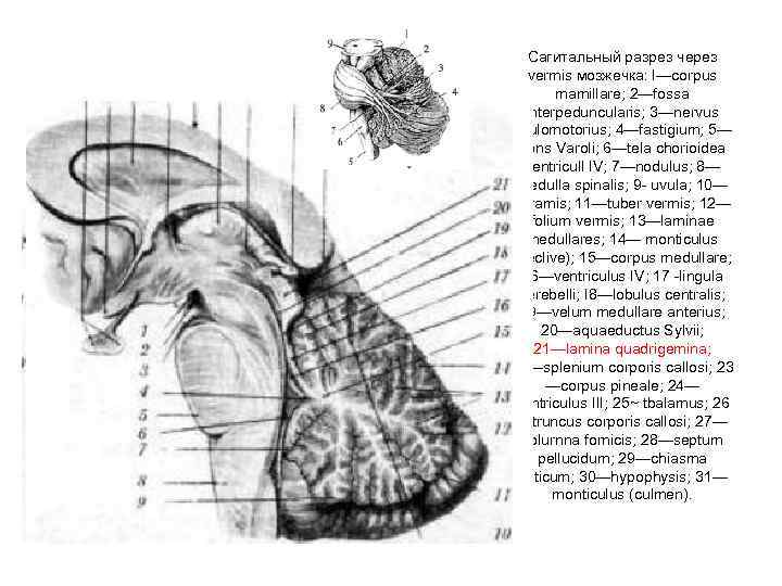 Сагитальный разрез через vermis мозжечка: I—corpus mamillare; 2—fossa interpeduncularis; 3—nervus oculomotorius; 4—fastigium; 5— pons