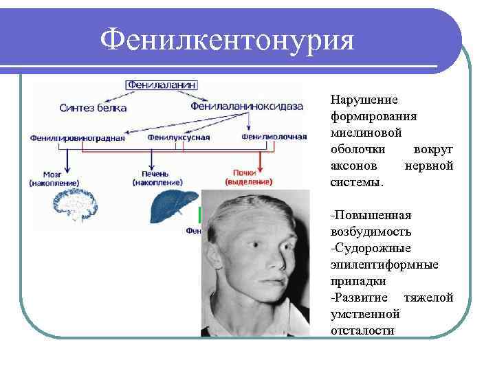 Фенилкентонурия Нарушение формирования миелиновой оболочки вокруг аксонов нервной системы. -Повышенная возбудимость -Судорожные эпилептиформные припадки