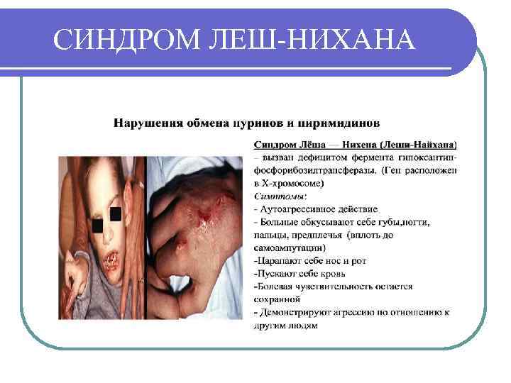 СИНДРОМ ЛЕШ-НИХАНА 