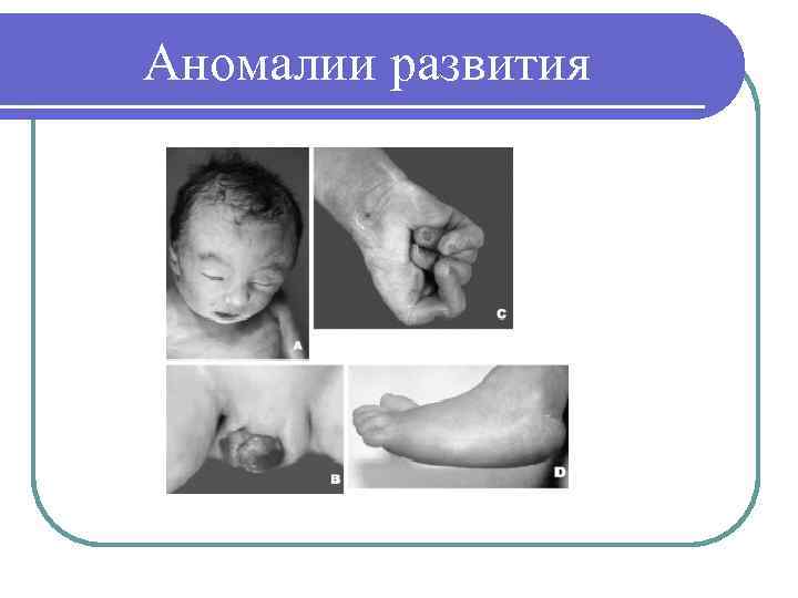Аномалии развития 