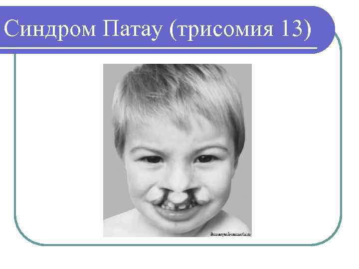 Синдром Патау (трисомия 13) 