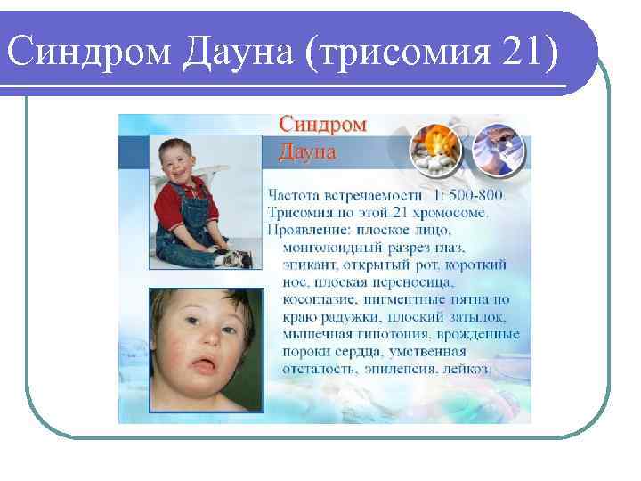 Синдром Дауна (трисомия 21) 