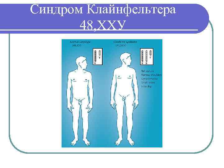 Синдром Клайнфельтера 48, ХХУ 