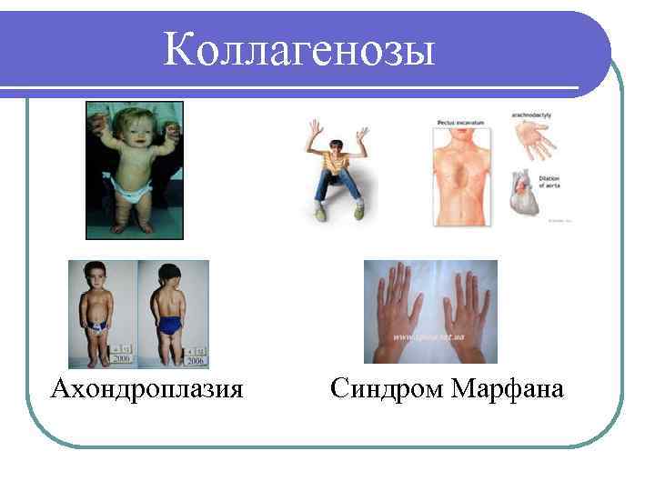 Коллагенозы Ахондроплазия Синдром Марфана 