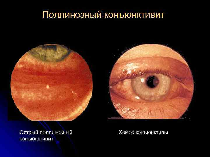 Поллинозный конъюнктивит Острый поллинозный конъюнктивит Хемоз конъюнктивы 