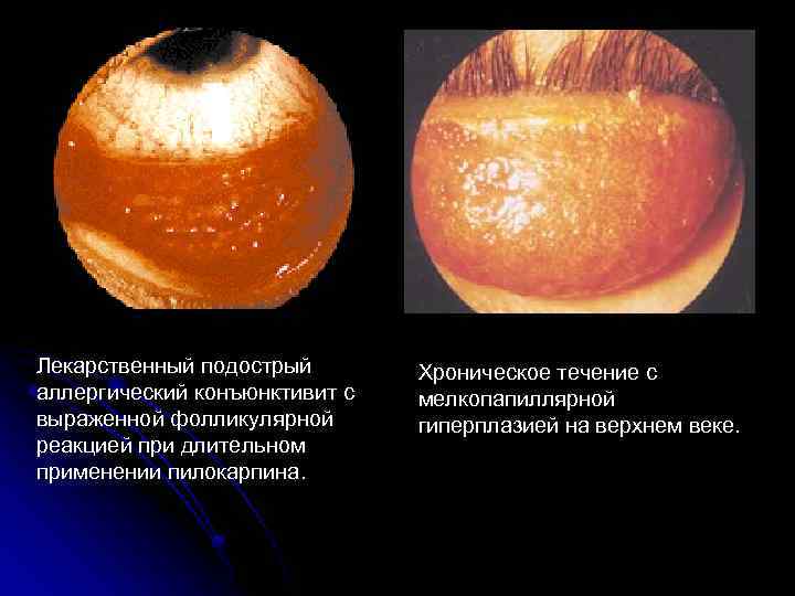 Лекарственный подострый аллергический конъюнктивит с выраженной фолликулярной реакцией при длительном применении пилокарпина. Хроническое течение