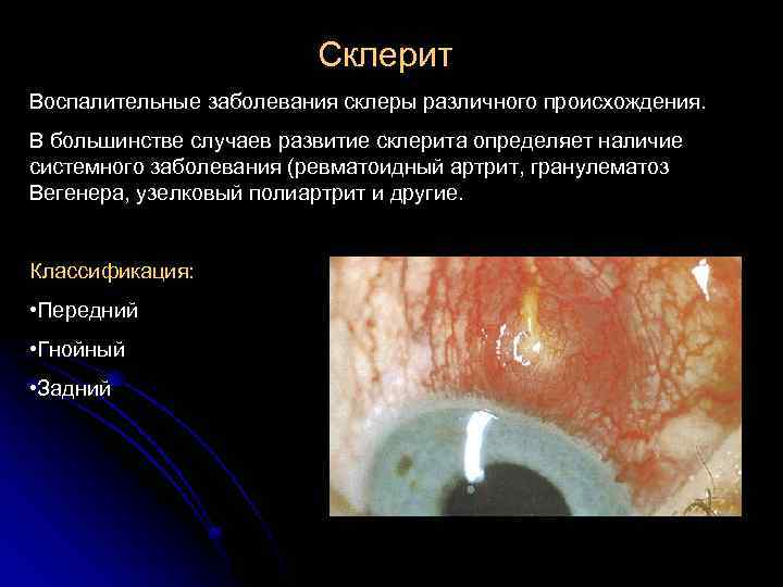 Склерит Воспалительные заболевания склеры различного происхождения. В большинстве случаев развитие склерита определяет наличие системного