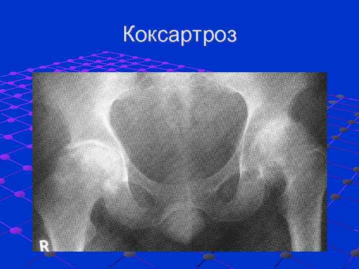 Какая рентгенологическая картина характерна для начальных форм коксартроза