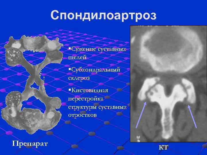 Спондилоартроз §Сужение суставных щелей §Субхондральный склероз §Кистовидная перестройка структуры суставных отростков Препарат КТ 