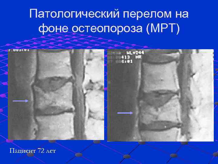 Патологический перелом на фоне остеопороза (МРТ) Пациент 72 лет 