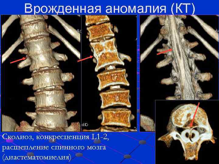 Презентация на тему расщепление позвоночника