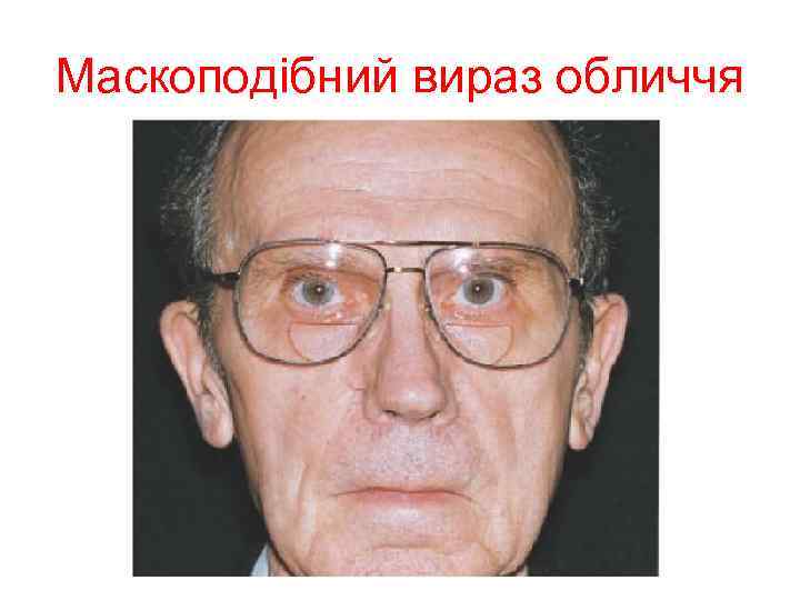Маскоподібний вираз обличчя 