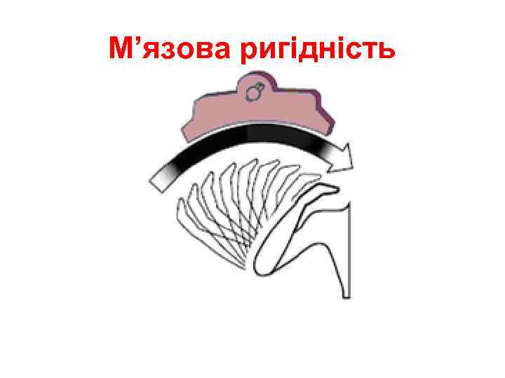 М’язова ригідність 