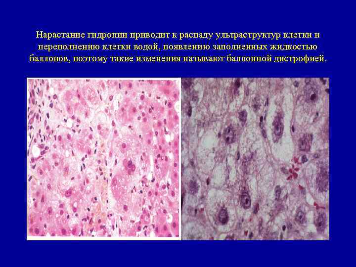 Нарастание гидропии приводит к распаду ультраструктур клетки и переполнению клетки водой, появлению заполненных жидкостью