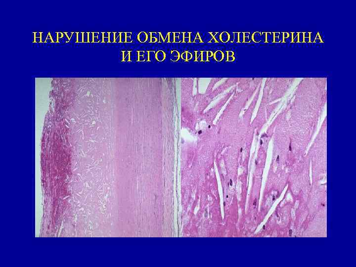 НАРУШЕНИЕ ОБМЕНА ХОЛЕСТЕРИНА И ЕГО ЭФИРОВ 