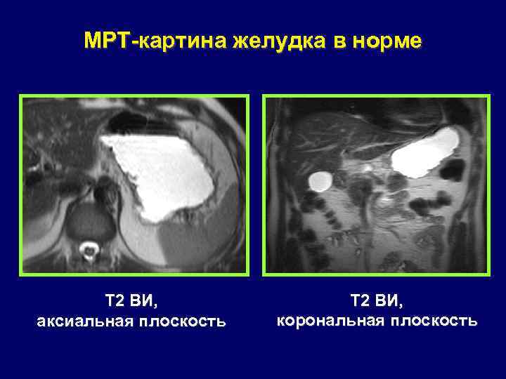 Мрт желудка и кишечника