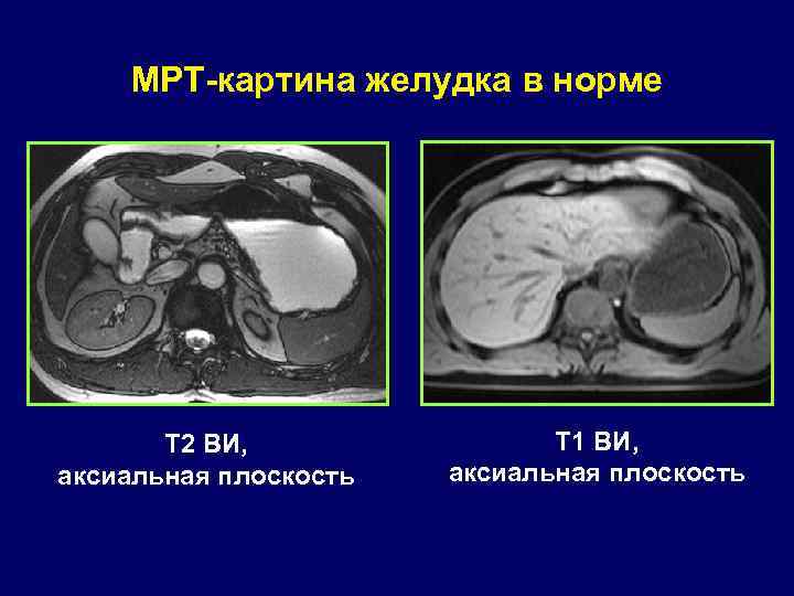 Магнитно-резонансная томография желудка. Мрт желудка
