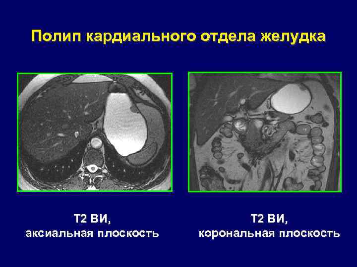 Полип кардиального отдела желудка Т 2 ВИ, аксиальная плоскость Т 2 ВИ, корональная плоскость