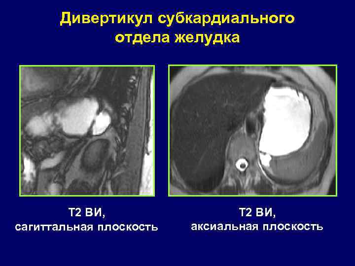 Дивертикул субкардиального отдела желудка Т 2 ВИ, сагиттальная плоскость Т 2 ВИ, аксиальная плоскость
