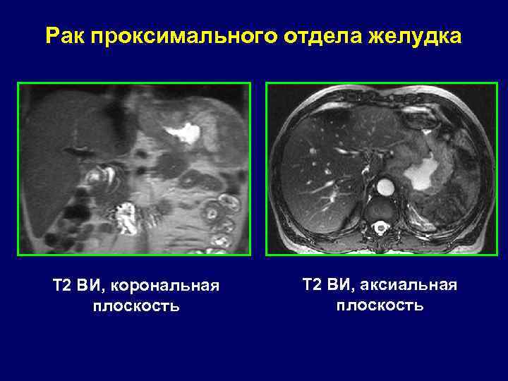 Рак проксимального отдела желудка Т 2 ВИ, корональная плоскость Т 2 ВИ, аксиальная плоскость
