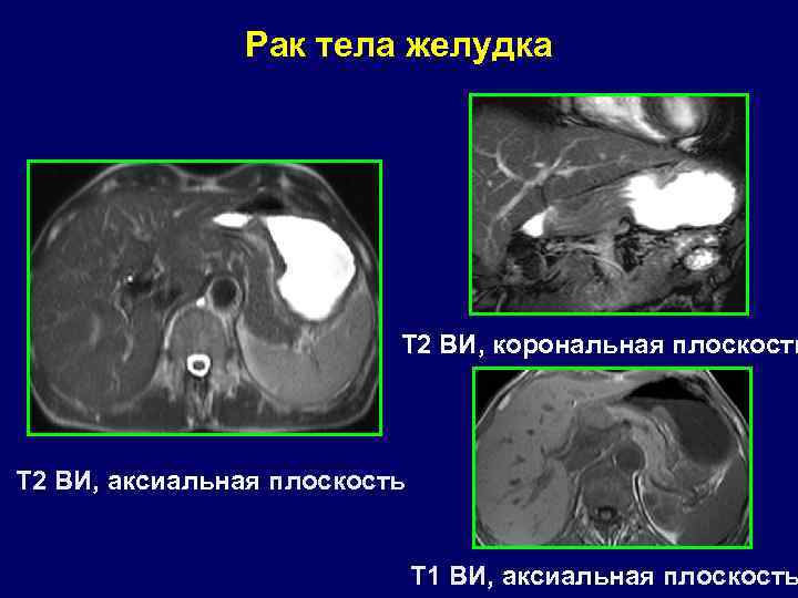 Рак тела желудка Т 2 ВИ, корональная плоскость Т 2 ВИ, аксиальная плоскость Т