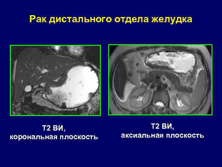 Рак дистального отдела желудка Т 2 ВИ, корональная плоскость Т 2 ВИ, аксиальная плоскость
