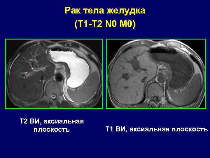 Рак тела желудка (T 1 -T 2 N 0 M 0) Т 2 ВИ,