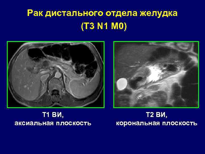 Рак дистального отдела желудка (T 3 N 1 M 0) Т 1 ВИ, аксиальная