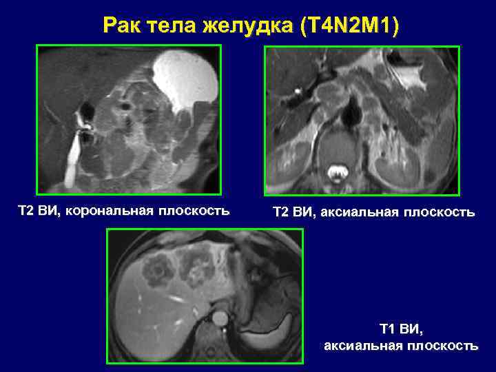 Рак тела желудка (T 4 N 2 M 1) Т 2 ВИ, корональная плоскость