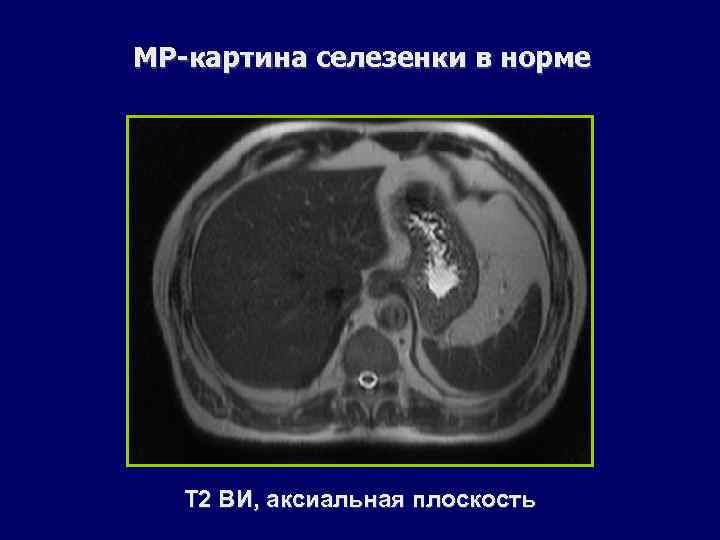 МР-картина селезенки в норме Т 2 ВИ, аксиальная плоскость 