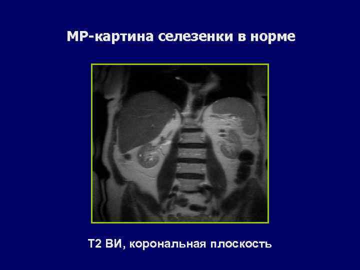 МР-картина селезенки в норме Т 2 ВИ, корональная плоскость 