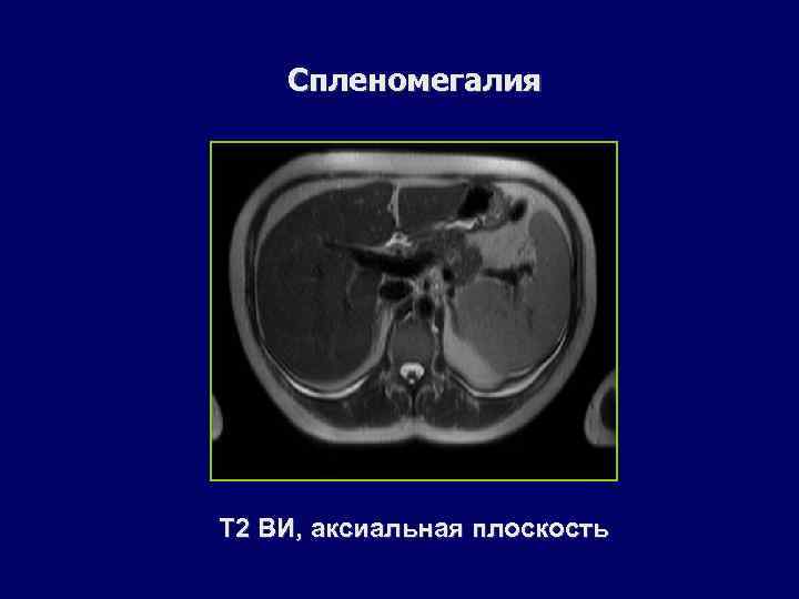 Спленомегалия Т 2 ВИ, аксиальная плоскость 