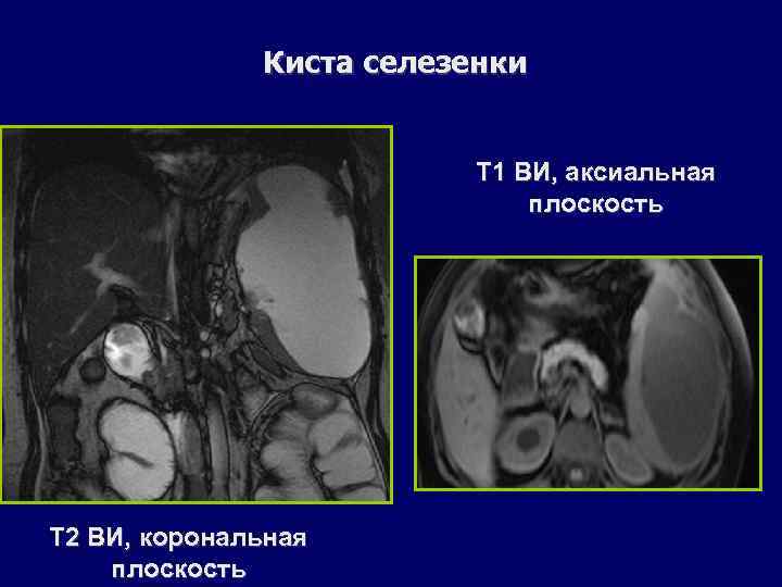 Киста селезенки Т 1 ВИ, аксиальная плоскость Т 2 ВИ, корональная плоскость 