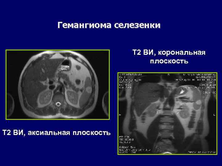 Гемангиома селезенки Т 2 ВИ, корональная плоскость Т 2 ВИ, аксиальная плоскость 