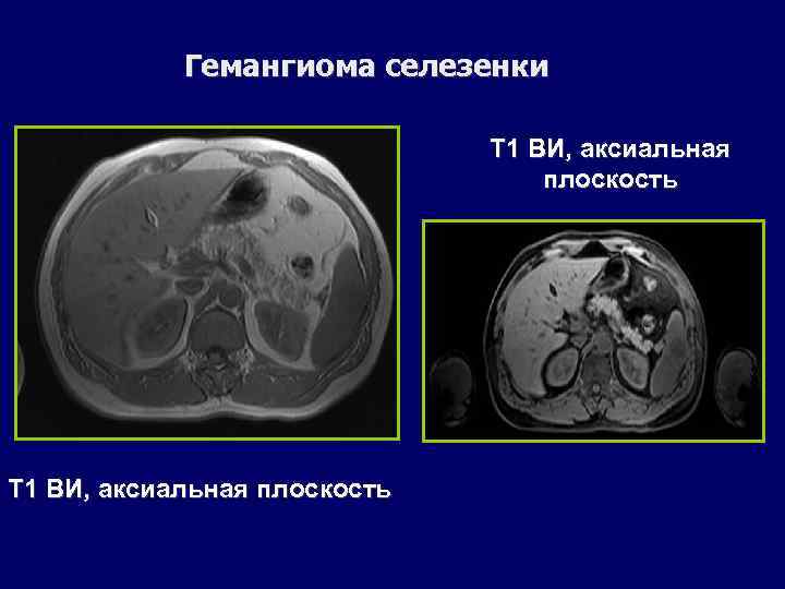 Гемангиома селезенки Т 1 ВИ, аксиальная плоскость 