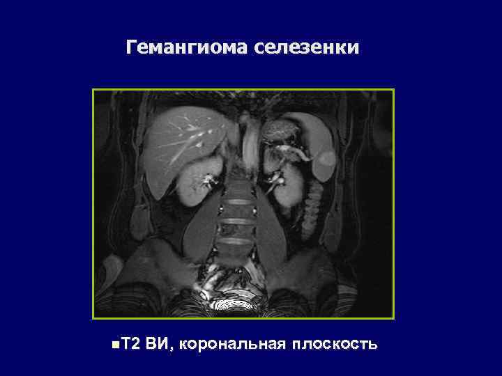 Гемангиома селезенки Т 2 ВИ, корональная плоскость 