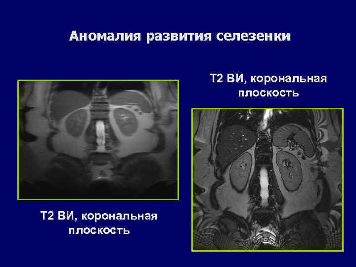 Аномалия развития селезенки Т 2 ВИ, корональная плоскость 