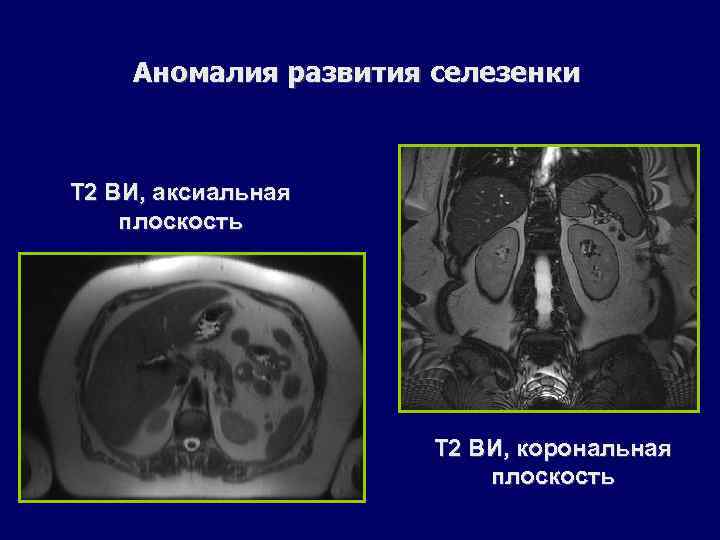 Аномалия развития селезенки Т 2 ВИ, аксиальная плоскость Т 2 ВИ, корональная плоскость 