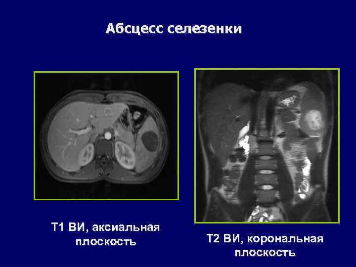 Абсцесс селезенки Т 1 ВИ, аксиальная плоскость Т 2 ВИ, корональная плоскость 
