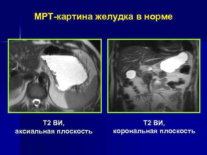 МРТ-картина желудка в норме T 2 ВИ, аксиальная плоскость Т 1 ВИ, аксиальная плоскость