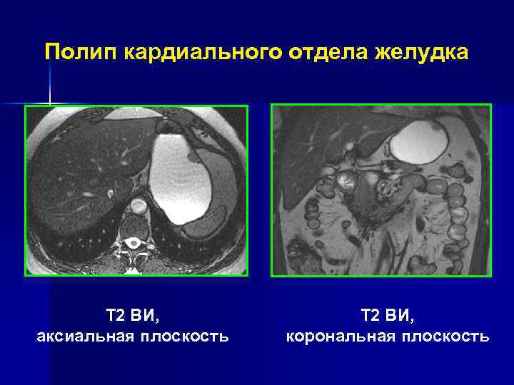 Лейомиома тела желудка Т 2 ВИ, корональная плоскость Т 2 ВИ, аксиальная плоскость 