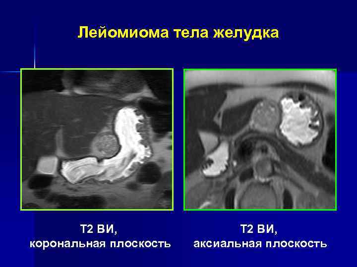 Лейомиома тела желудка Т 1 ВИ, аксиальная плоскость 