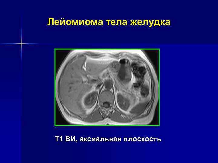 Дивертикул субкардиального отдела желудка Т 2 ВИ, сагиттальная плоскость Т 2 ВИ, аксиальная плоскость