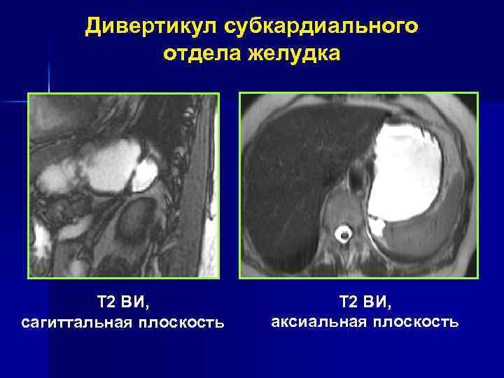 МРТ-семиотика злокачественных опухолей желудка МР-признаки Рак желудка Абс. % Объемное образование в виде утолщения
