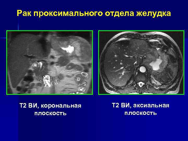 Рак тела желудка Т 2 ВИ, корональная плоскость Т 2 ВИ, аксиальная плоскость Т