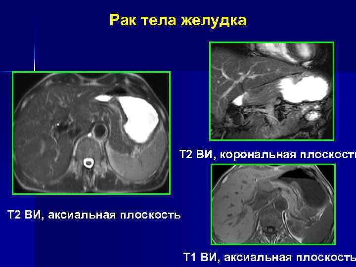 Рак дистального отдела желудка Т 2 ВИ, корональная плоскость Т 2 ВИ, аксиальная плоскость
